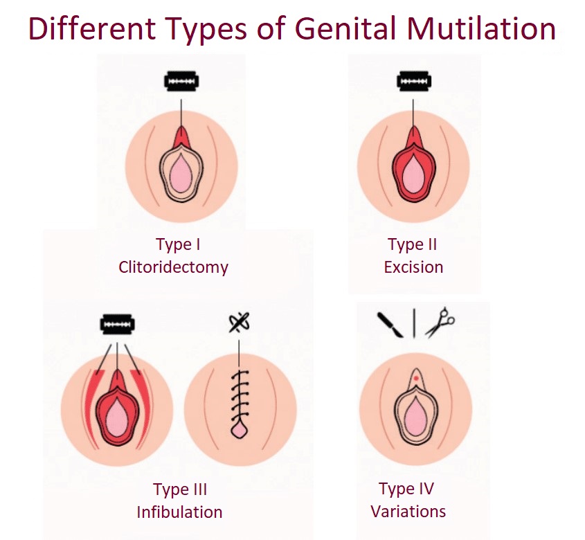 Types of FGM